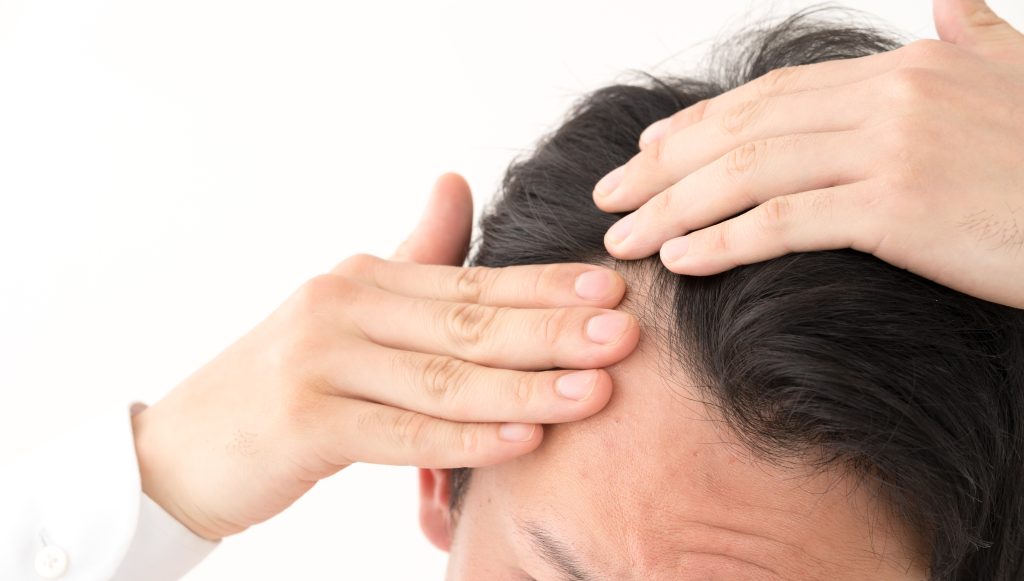 頭頂部の薄毛はAGAの初期症状？思い込みとの見分け方や治療法を解説