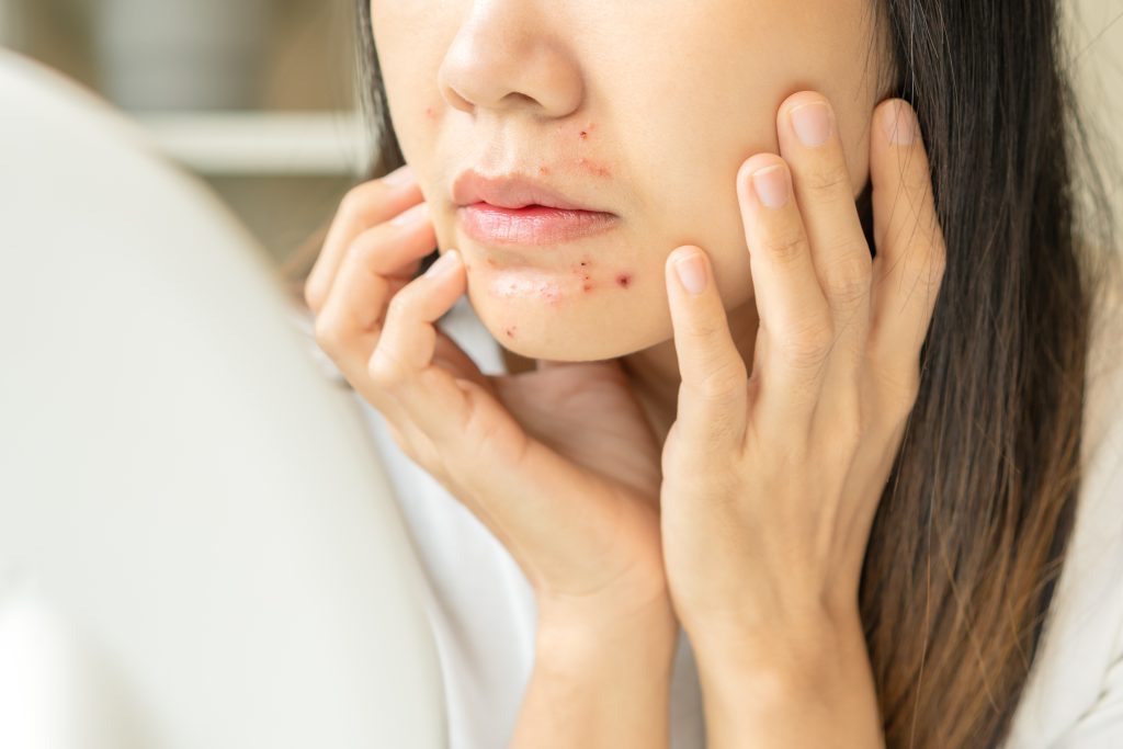 ニキビは何日で治る？種類別の治るまでの期間や早く治す方法を解説